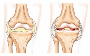 Гонартроз колінного суглоба симптоми і лікування