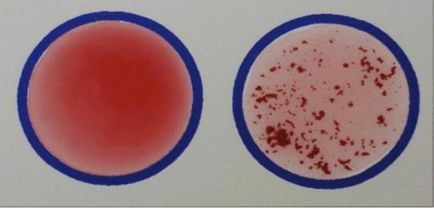 Групи крові схема переливання крові, резус-фактор