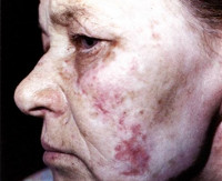 Integumentnaya lupus erythematosus - okok, tünetek, diagnózis és kezelés