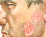 Erithematosul lupus integrat - cauze, simptome, diagnostic și tratament