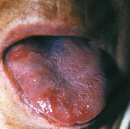 Зміни слизової оболонки порожнини рота при захворюваннях шлунково-кишкового тракту