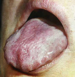 Зміни слизової оболонки порожнини рота при захворюваннях шлунково-кишкового тракту
