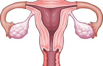Cum să tratați inflamația ovariană la femei