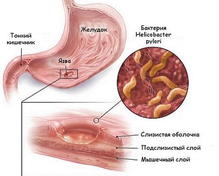 Cum de a trata ulcerul la stomac la medicamentele de uz casnic și medicamentele