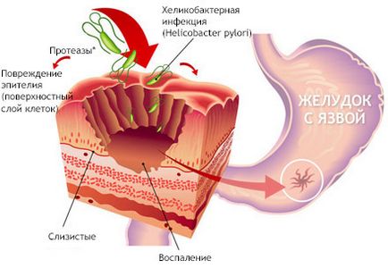 Як лікувати виразку шлунка в домашніх умовах народні засоби і медикаменти