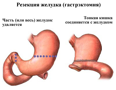 Як лікувати виразку шлунка в домашніх умовах народні засоби і медикаменти