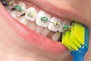 Cum este tratamentul ortodontic pe bretele
