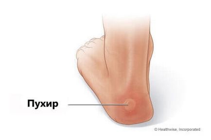 Як прибрати пухирі на п'ятах природними методами