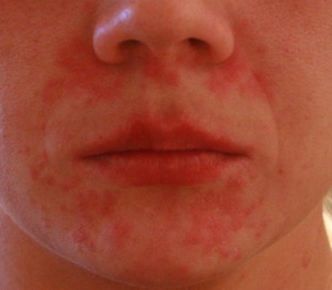 Mi dermatitis gyermekeknél és felnőtteknél