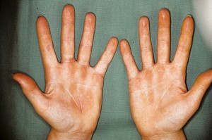 Mi dermatitis gyermekeknél és felnőtteknél