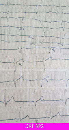 EKG az egészséges emberi szív
