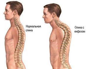 Kyphosis a mellkasi gerinc (háti kyphosis) kezelési