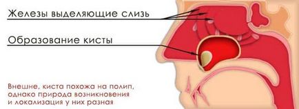 Chistul de tratament nazal sinusal fără remedii folclorice