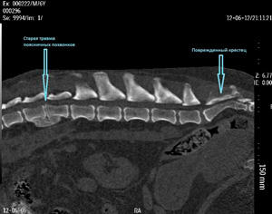 Комп'ютерна томографія (кт) попереково-крижового, шийного і грудного відділів хребта