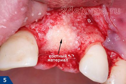 Obiectiv plastic din oase, eficacitate, feedback