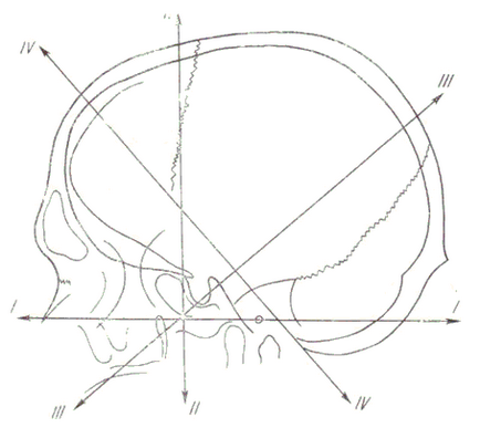 Craniografia (radiografie a oaselor craniului)