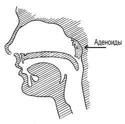 лікування аденоїдів