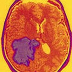 astrocytoma külföldi kezelés új módszerekkel