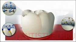Лікування емалі чутливих зубів; витончення емалі зубів лікувати в москві; гіперчутливість