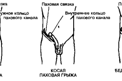 Tratamentul simptomelor herniei inghinale și cauzele, diagnosticul, prevenirea și complicațiile