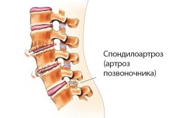 Tratamentul spondilartrozei