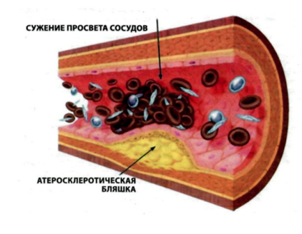 Tratarea heleborei bolilor cardiovasculare