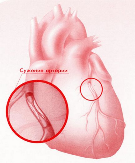 Tratarea heleborei bolilor cardiovasculare