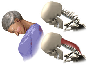 Lfk cu osteocondroză - un complex de exerciții fizice și gimnastică terapeutică