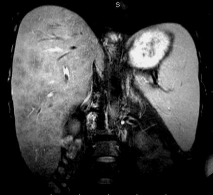 Променева діагностика цирозу печінки (огляд літератури) imaging in liver cirrhosis (review article)