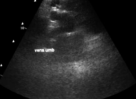 Променева діагностика цирозу печінки (огляд літератури) imaging in liver cirrhosis (review article)