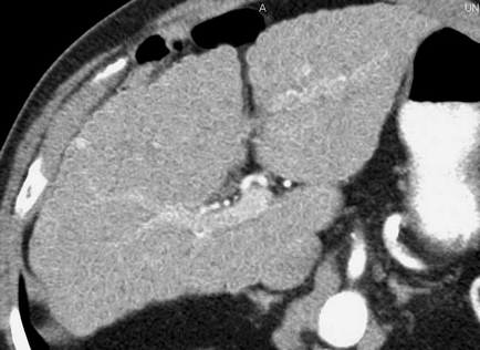 Diagnosticul de radiație a cirozei hepatice (revizuirea literaturii) imagistică în ciroza hepatică (articol de revizuire)