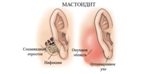 Mastoidita la stânga, față-verso și bilaterală