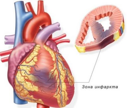 Метаболічні зміни в міокарді