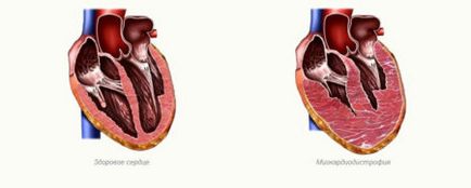 Schimbări metabolice ale miocardului