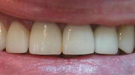 Fém-kerámia korona az első fogak egy fotó előtt és után
