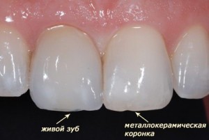 Ceramica coroane ceramice, stomatologie