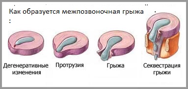 Міжхребцева грижа симптоми, лікування, операція, причини