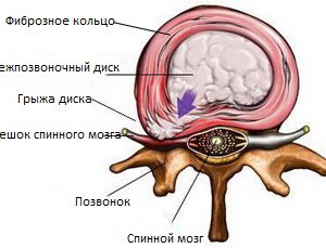 Intervențiile herniei intervertebrale, tratamentul, intervențiile chirurgicale, cauzele