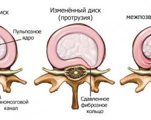 Міжхребцева грижа симптоми, лікування, операція, причини