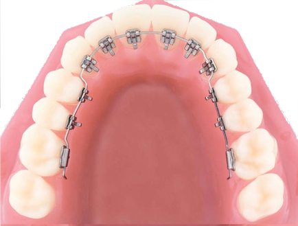 Міфи про брекетах, стоматологія