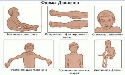 Міопатія Дюшена-Беккера, Ландузі-Дежеріна, Ерба-рота що таке, причини, симптоми