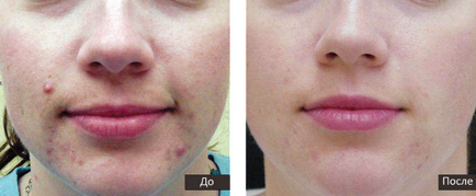 Este posibil să ștergeți fața cu clorhexidină pentru întinerirea pielii?