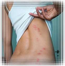 Remedii populare pentru mușcăturile de țânțari
