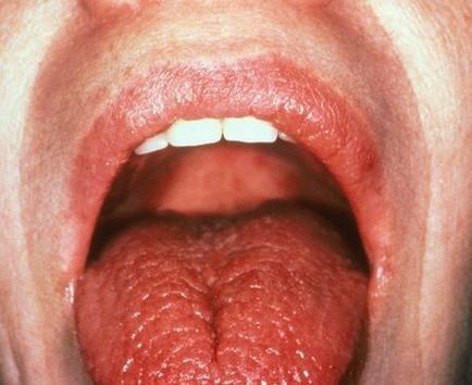 Tulburări de salivare - hipersalivare și hipo-salivare