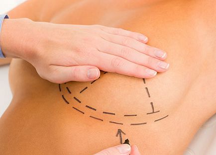 A negatív hatások a emlő implantátumok (implantátumok) A negatív hatások mellimplantátumok