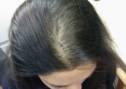 Alopecia areata la femei - tratament și cauze