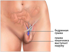 Működés femorális sérv, kezelési módszerek és műanyag
