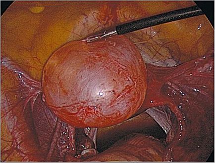 Formarea tumorii a apendicelor uterine