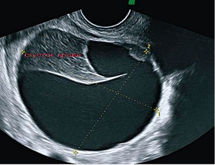 Formarea tumorii a apendicelor uterine