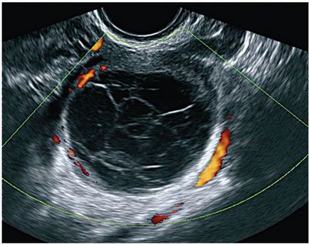 Formarea tumorii a apendicelor uterine